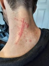 Morgellons - Bartonellosis: Cat Scratch Disease, Carrion’s Disease, Trench Fever, and Bartonella Endocarditis