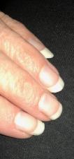 Morgellons - Turning the Corner