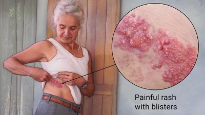 Morgellons - Shingles