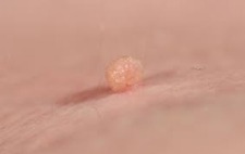 Morgellons - Skin tags and Morgellons