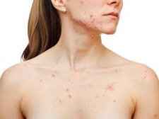 Morgellons - Malassezia Yeast Questions for Dr. Bell